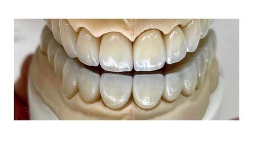 Ceramic Crowns and Bridges Fixing